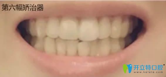 佩戴第6副隱形矯正器的照片 佩戴第6副隱形矯正器的照片