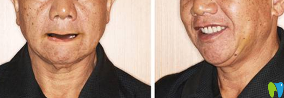 老年人能做即刻種植牙嗎