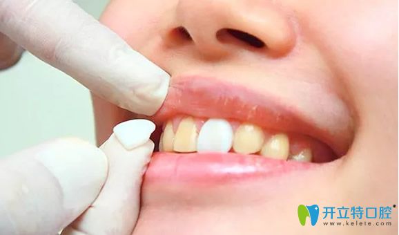 牙齒瓷貼面適合牙齒黑黃比較多的顧客 牙齒瓷貼面適合牙齒黑黃比較多的顧客