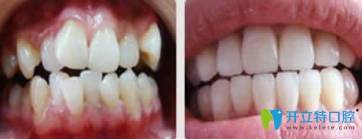 28歲矯正牙齒前后對比照片