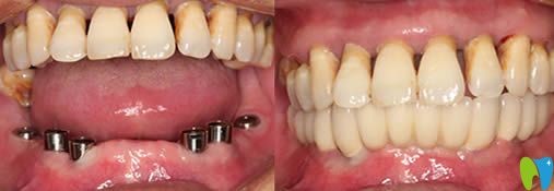 青島西諾德口腔半口牙種植前后對(duì)比圖 青島西諾德口腔半口牙種植前后對(duì)比圖