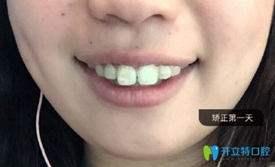 戴上第1副隱形牙套