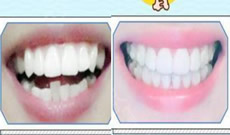 齙牙在廣州歐頓口腔做隱形矯正650天，來(lái)曬牙齒變化圖啦