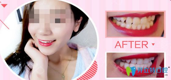 歐頓口腔納米炫薄瓷貼面修復(fù)牙齒案例