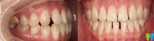 大連美麗雅口腔牙齒矯正前 大連美麗雅口腔牙齒矯正前