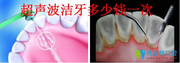 超聲波潔牙價(jià)格