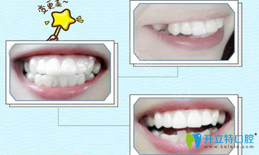 廣州歐頓口腔隱形矯正第1天