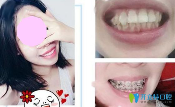 廣州歐頓口腔美國3M金屬托槽牙齒矯正案例