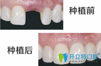 開立特口腔種植牙前后對(duì)比圖