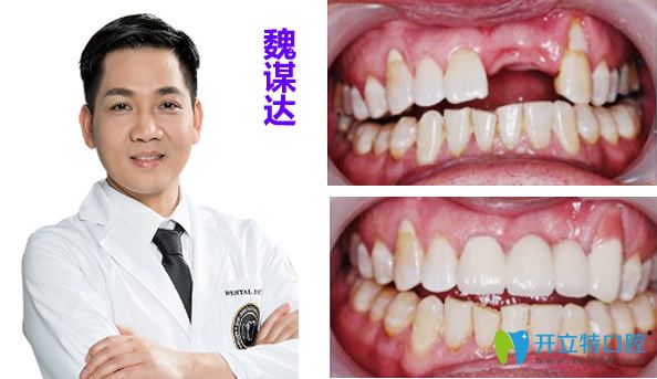 南京牙博士口腔魏謀達種植牙效果案例