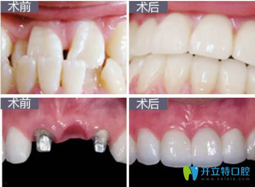 西安海濤口腔趙海濤院長(zhǎng)種植牙真實(shí)案例