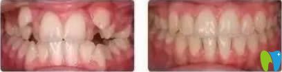 西安海濤口腔程錦醫(yī)生兒童牙齒矯正前后對比照