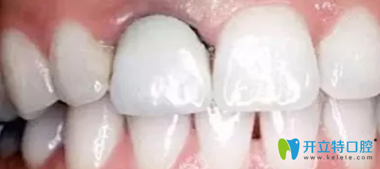 烤瓷牙后頸緣處的牙齦組織出現(xiàn)了“黑線”