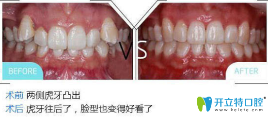 黃飛醫(yī)生給我做虎牙矯正前后對(duì)比圖
