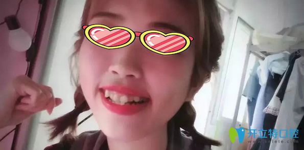 <!--<i data=20240703-sp></i>-->口腔金屬托槽矯正牙齒前