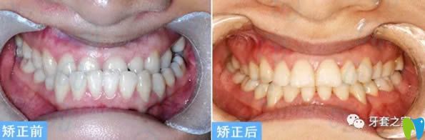 杭州齊爾口腔李詩佩地包天牙齒矯正案例及前后對比照