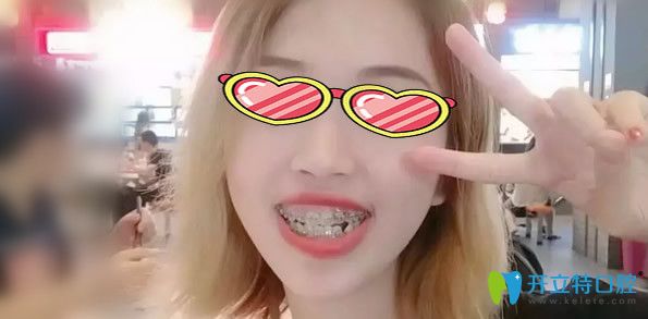 戴牙套矯正牙齒6個月恢復效果