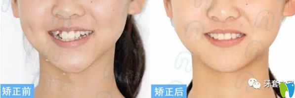 李詩佩青少年安氏I類錯合固定矯正案例