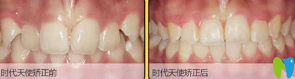 隋冬梅深覆頜采用時代采用時代天使隱形矯正案例對比圖