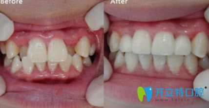 呼和浩特紅十字口腔隱適美隱形牙齒矯正前后效果對比圖