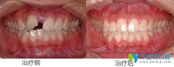 屬于天津美萊口腔的牙齒錯(cuò)位、牙間縫矯正案例