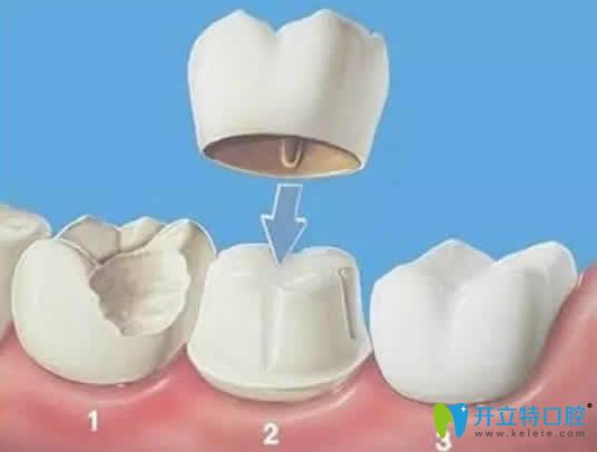 烤瓷牙能用幾年
