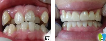 壹加壹口腔矯正牙齒前后療效對(duì)比