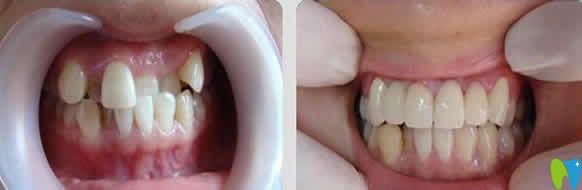 嘉悅口腔牙齒矯正前后對(duì)比圖 嘉悅口腔牙齒矯正前后對(duì)比圖