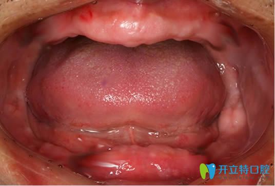 我?guī)Я?0年的活動(dòng)假牙，沒做種植牙卻讓活動(dòng)假牙害我一生啊