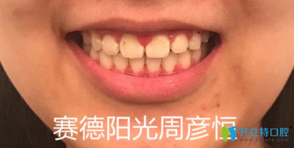 深圳賽德陽關(guān)口腔金屬托槽矯正牙齒效果怎么樣
