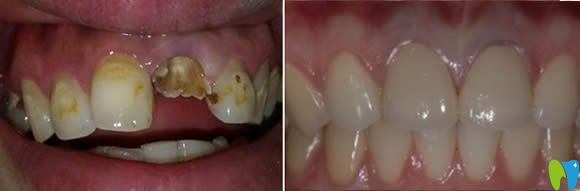 大連昭鶴口腔李文顏牙齒修復(fù)效果圖