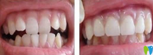 蘭州惠安齒科牙齒矯正前后對比圖 蘭州惠安齒科牙齒矯正前后對比圖