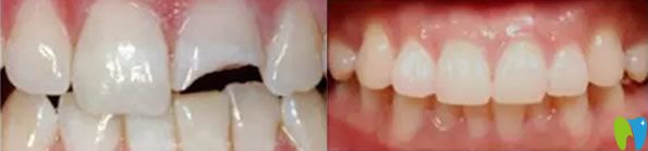 門(mén)牙掉了一塊補(bǔ)后效果對(duì)比圖