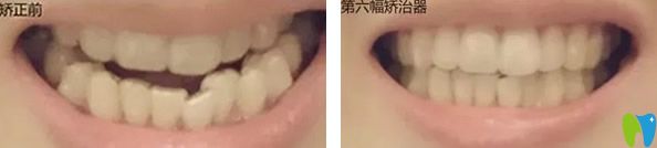 矯正前和戴第六幅隱形牙套正畸效果對比