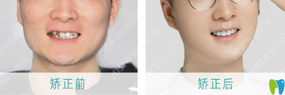 珠海愛思特怎么樣呢？來看顧客真人牙齒矯正案例