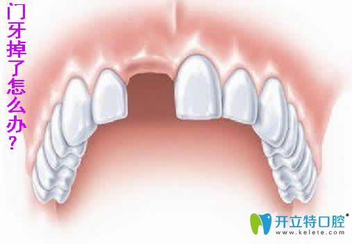 想知道20多歲門牙掉了怎么辦？能做種植牙嗎