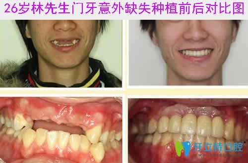門牙意外缺失種植前后對比圖