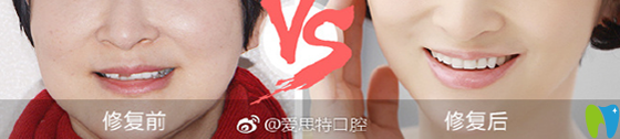 在愛思特口腔進(jìn)行進(jìn)口全瓷牙美學(xué)修復(fù)案例前后效果對(duì)比圖