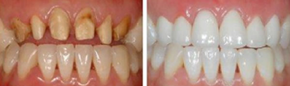 牙齒缺損掉落什么原因 成都皓雅口腔揭曉牙齒缺損修復(fù)方法