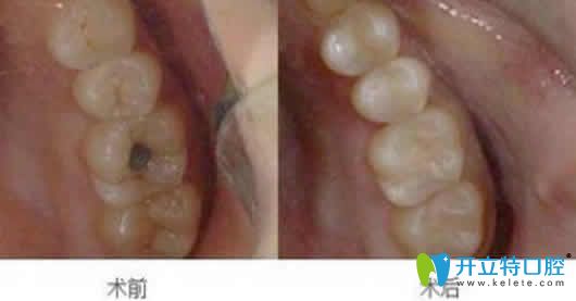 根管治療后牙疼怎么辦