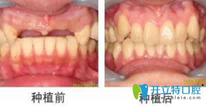 無錫金貝齊齒科尹亮種植牙效果圖 無錫金貝齊齒科尹亮種植牙效果圖
