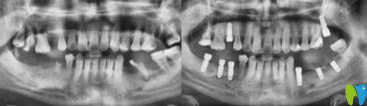 東莞好佰年口腔周勇好不好？來看真人案例