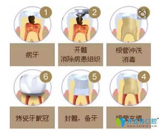 根管治療的步驟圖