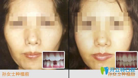 南昌安植雅口腔張明智種植牙案例效果圖