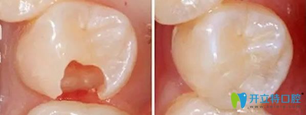 嵌體修復(fù)效果對(duì)比圖