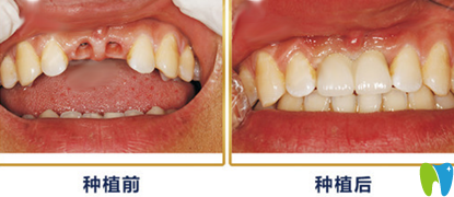 重慶種植牙哪家好？來看牙衛(wèi)士口腔種植牙案例效果