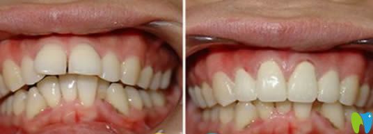 寧波壹加壹口腔茅來發(fā)主任牙齒正畸效果圖 寧波壹加壹口腔茅來發(fā)主任牙齒正畸效果圖