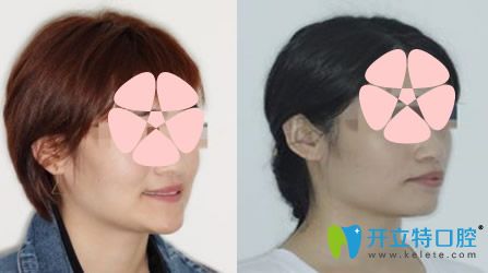 天津英瑞齒科怎么樣，地包天矯正案例來驗(yàn)證