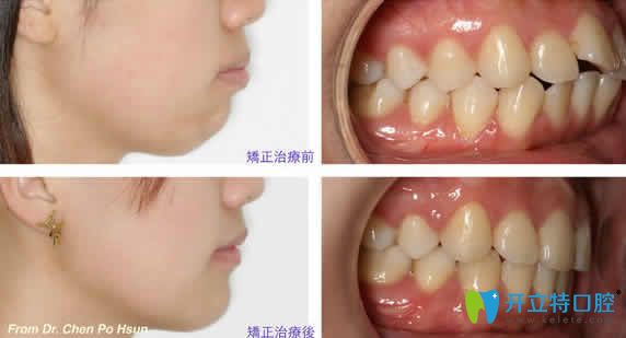 ?？趪?guó)雅口腔符基慶醫(yī)生隱形牙齒矯正案例效果圖