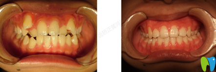 肖丹娜兒童牙齒矯正案例